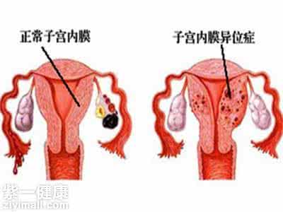 子宫内膜异位症的症状 子宫内膜异位症怎么治 子宫内膜异位症有哪些症状