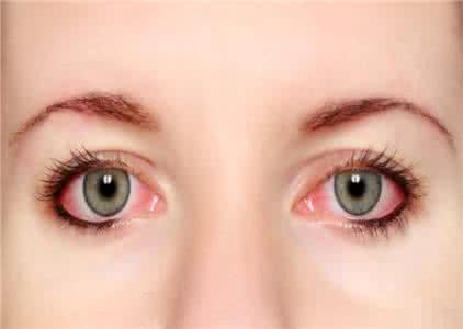 白眼球有血丝怎么办 眼球有血丝 眼睛有血丝怎么办？