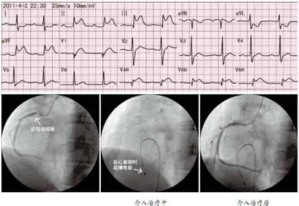 心肌梗死心电图表现 右心室心肌梗死 右心室心肌梗死的临床心电图表现