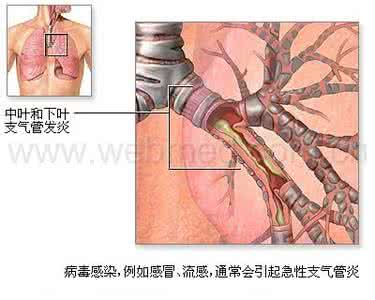 慢性支气管炎如何根治 急慢性支气管炎 如何根治急慢性支气管炎