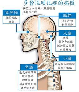 多发性硬化症能治吗 多发性硬化症 只需几招远离多发性硬化症