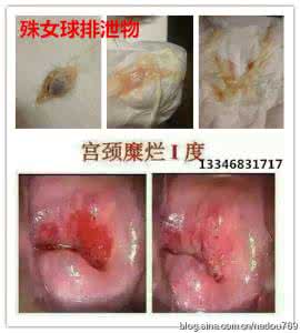 白带增多是什么症状 白带减少或增多 教您正确辨认症状