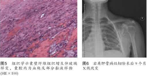 动脉瘤样骨囊肿 动脉瘤样骨囊肿治疗 动脉骨囊肿的鉴别诊断