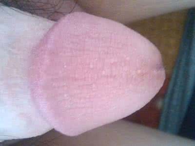 龟头旁边长几个肉丁 龟头上有几个小肉粒怎么回事呢?