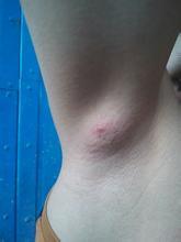 腋下肿块疼痛挂什么科 腋下肿块疼痛挂什么科？