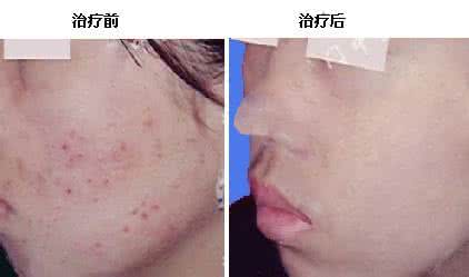 脸上长痘痘部位图 脸上长痘痘部位图 牛皮癣长在什么部位?