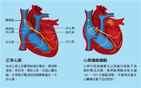 房颤的临床表现 心脏房颤 心脏房颤有哪些临床表现