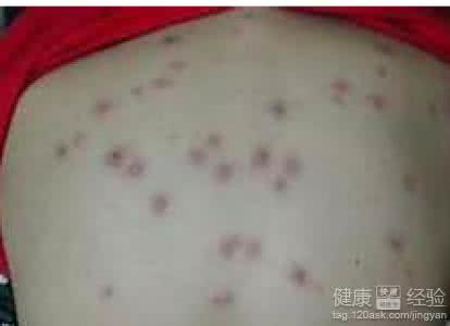 败血症有什么症状 败血症症状 什么是败血症
