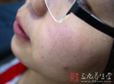 去除脸上螨虫的小妙招 去除脸上螨虫的小妙招 脸上的小疙瘩是螨虫吗？