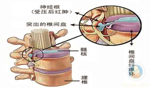 根治型排毒拔罐疗法 治腰椎间盘突出 腰椎间盘突出的拔罐疗法