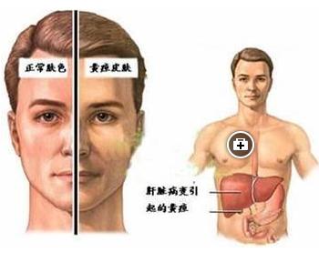 急性黄疸型肝炎 急性黄疸型肝炎 急性黄疸型肝炎如何护理
