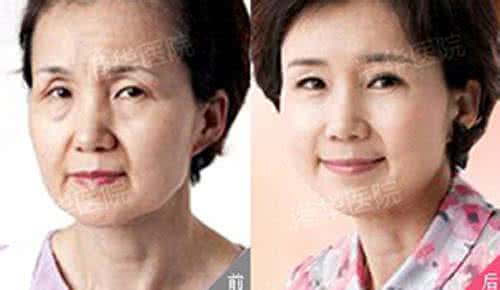 手术去皱比除皱针好吗 面部除皱 面部去皱