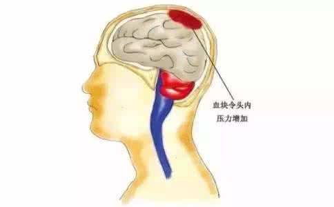 脑血管破裂的原因 脑血管破裂的原因 脑血管破裂前10个信号，千万别等半身不遂才看到！