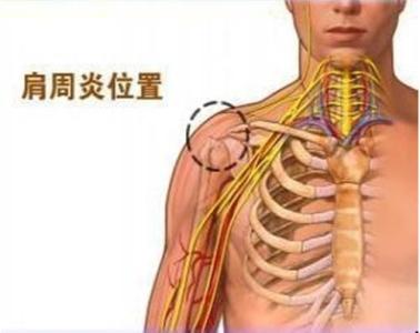 胳膊无力抬不起来 肩周炎胳膊抬不起来,怎么办?