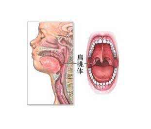 慢性扁桃体炎症状 慢性扁桃体炎症状 慢性扁桃体4大症状 可服2款药膳