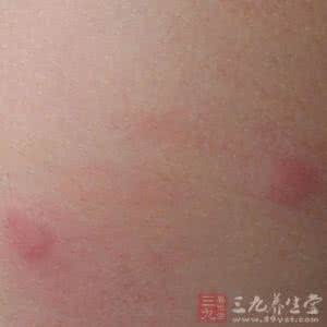 像蚊子咬的荨麻疹图片 什么是荨麻疹 没蚊子身上也起包竟是这病