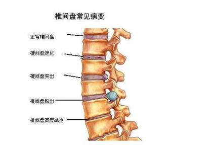 针灸治疗腰椎间盘突出 腰椎间盘突出怎么治 针灸治疗效果显著