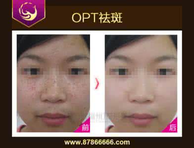 激光祛雀斑效果好吗 激光祛雀斑的优点是什么?