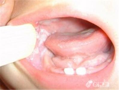 婴儿口腔溃疡怎么办 婴儿口腔溃疡怎么办 婴儿口腔有点白是怎么回事