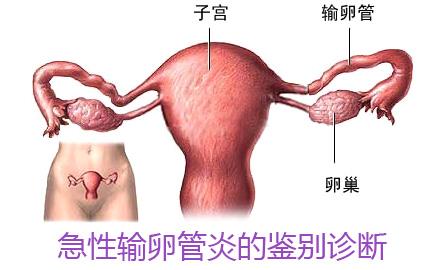 急性输卵管炎 区别宫外孕与急性输卵管炎
