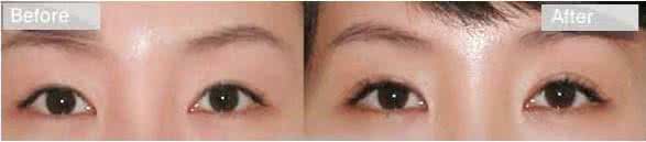 割的双眼皮图片对比 割双眼皮对比图 割双眼皮前后对比图