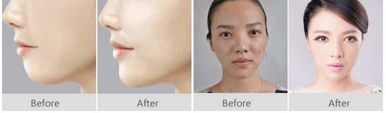 注射玻尿酸丰下巴 注射玻尿酸丰下巴 怎么注射玻尿酸丰下巴方法