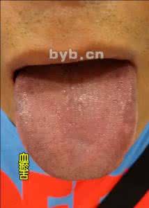 舌苔发白是怎么回事 舌苔发白是有病吗 舌苔发白是怎么回事？