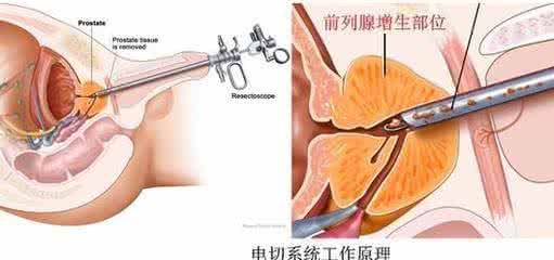 前列腺增生怎么治疗 前列腺增生治疗 哪些食物可治前列腺增生