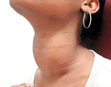 甲状腺弥漫病变与甲减 甲减的症状 9个表现预示甲状腺病变