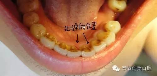 去牙结石的最好方法 去牙结石的最好方法 去牙石最好的方法是什么呢