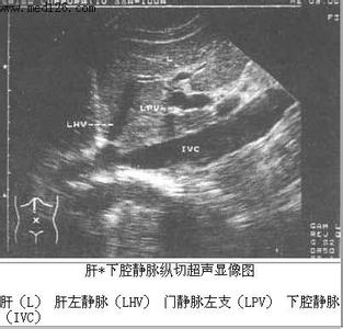 正常ct解剖袖珍图谱 正常肝脏B超解剖图谱