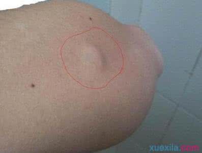 皮下脂肪瘤治疗偏方 皮下脂肪瘤效方