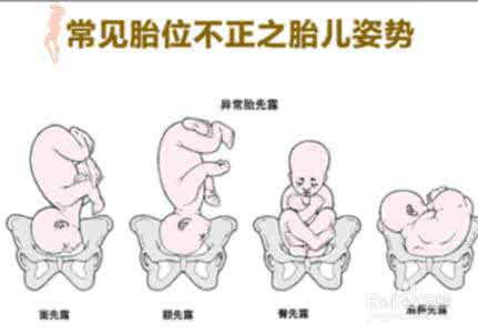 什么情况必须剖腹产 哪些情况必须选择剖腹产