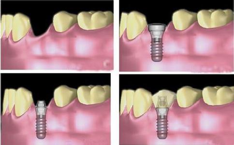 种植牙的过程 种植牙过程 种植牙的过程是怎样的？