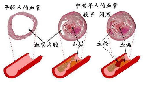 心血管年轻疗法 让你的身体更年轻，试试吃点血管“清道夫”