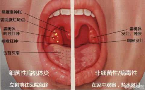 乳蛾 第五案 乳蛾发热