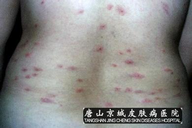 治疗慢性荨麻疹的方法 慢性荨麻疹症状 慢性荨麻疹的护理方法