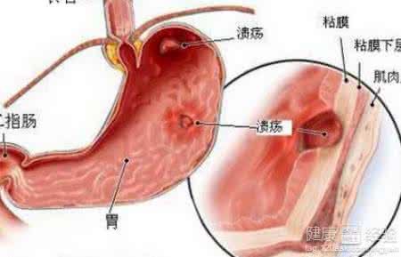 十二指肠溃疡治疗法 十二指肠溃疡治疗法 十二指肠溃疡会拉肚子吗 拉肚子治疗法