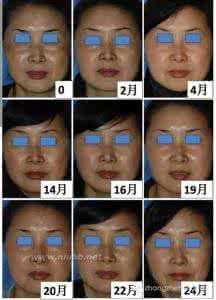 氨甲环酸治疗黄褐斑 氨甲环酸治疗黄褐斑 究竟是什么原理