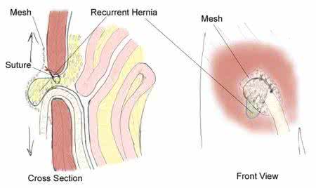 腹股沟斜疝 腹股沟斜疝 你对它了解多少