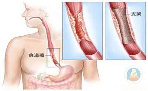 食道癌的治疗 食道癌 治疗食道癌