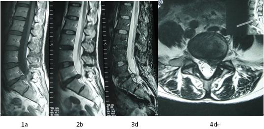 第三腰突综合症 第三腰突综合症 腰突 椎间盘与MRI影像：T2图 之三