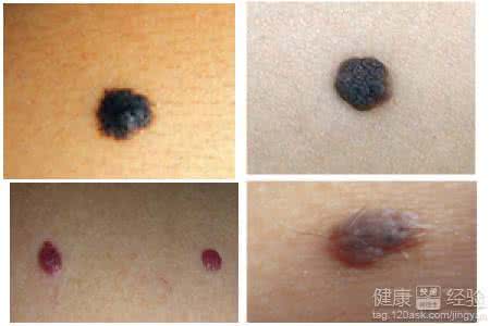 黑痣发炎的症状 黑痣都包括哪些症状