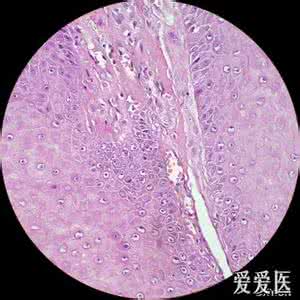 妊娠合并hiv hiv合并尖锐湿疣 妊娠合并尖锐湿疣