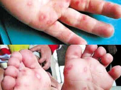 手足口会传染给大人吗？