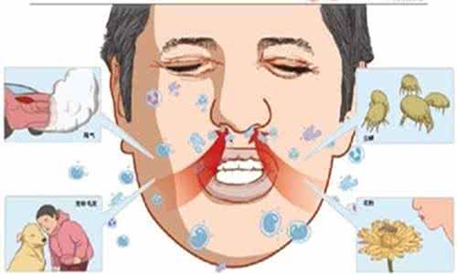 过敏性鼻炎物理治疗 过敏性鼻炎根源在哪 完全被忽略的这物 竟成过敏根源！