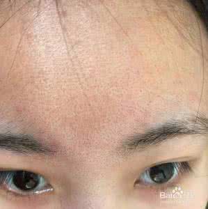 脸上毛孔粗大怎么办 脸上毛孔大怎么办 脸上毛孔粗大怎么办