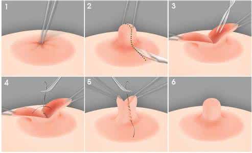 乳头内陷矫正术价目表 乳头内陷矫正术 矫正方法是什么