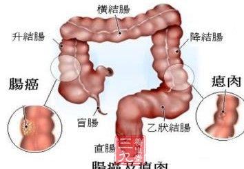 最易发生胃癌的部位 11个人体部位 最易患癌