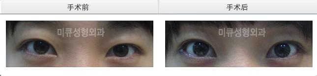 内眦与外眦 外眦角大于内眦角 内眦与外眦手术比较